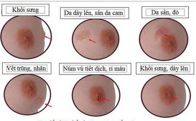 Bạn có nguy cơ ưng thư vú không?