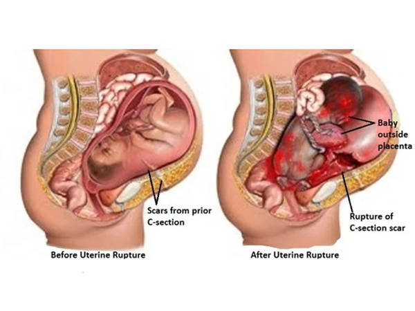 PHẢN HÔI BÀI VIẾT “ Bệnh Nhân Tử Vong Do Vỡ Tử Cung” (05/7/19)