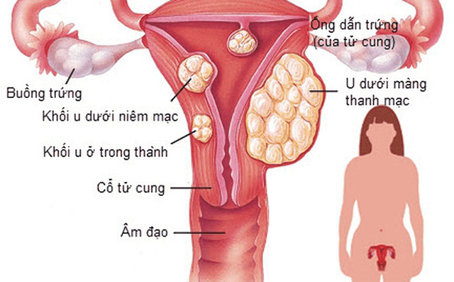 U xơ tử cung