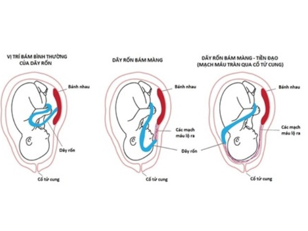 Dây rốn bám màng