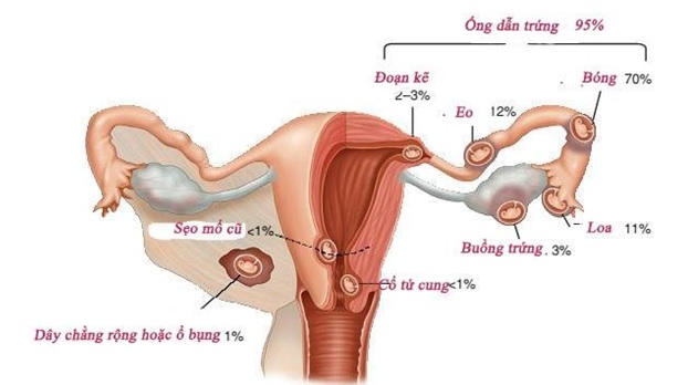 CHỬA NGOÀI TỬ CUNG